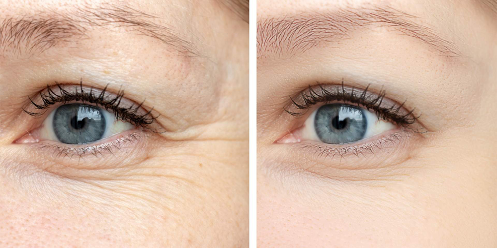 Invecchiamento cutaneo: il contorno occhi
