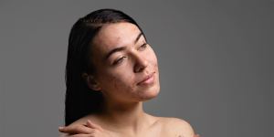 Il sole e le discromie cutanee