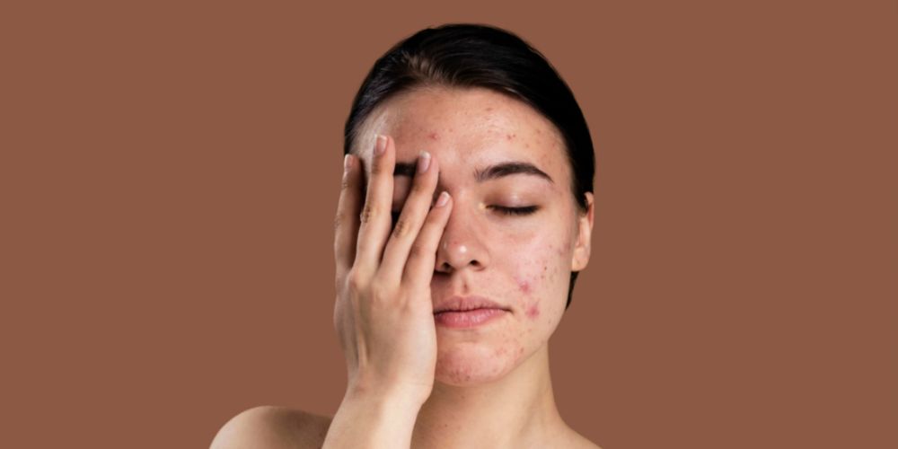 SOS acne cistica: fornisci la soluzione alle tue clienti