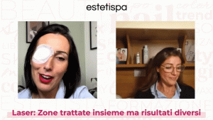 live Laser: zone trattate insieme ma risultati diversi